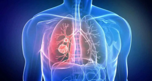 Ознакою раку легенів може бути зміна голосу